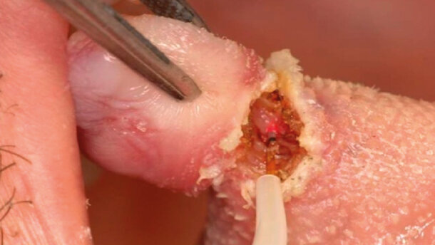 Dolore e qualità di vita in seguito a 118 interventi di chirurgia orale sui tessuti molli: i vantaggi del laser Nd:YAG