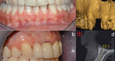 Uso di innesto osseo e membrana corticale equina per Guided Bone Regeneration nella zona estetica