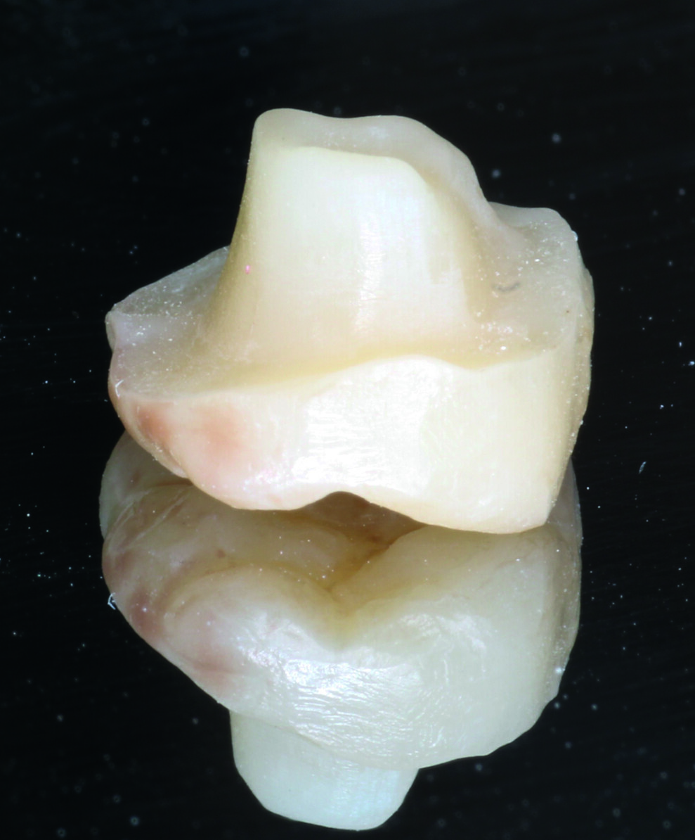 Fig. 10: Final endocrown upside down.