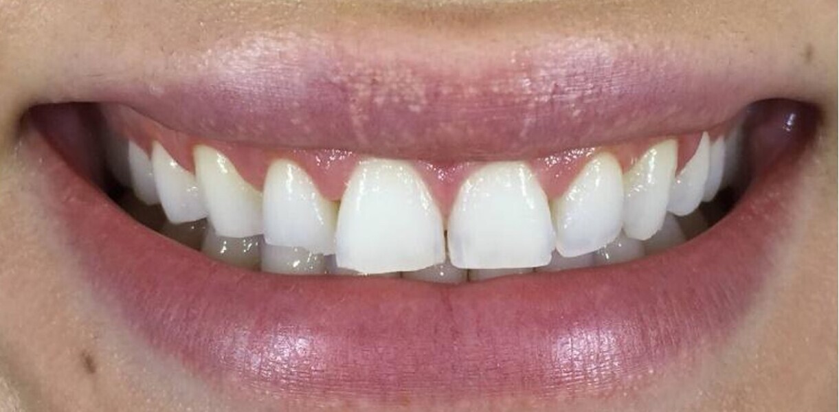 Fig. 10: Close-up view of the patient’s smile after soft-tissue recontouring.