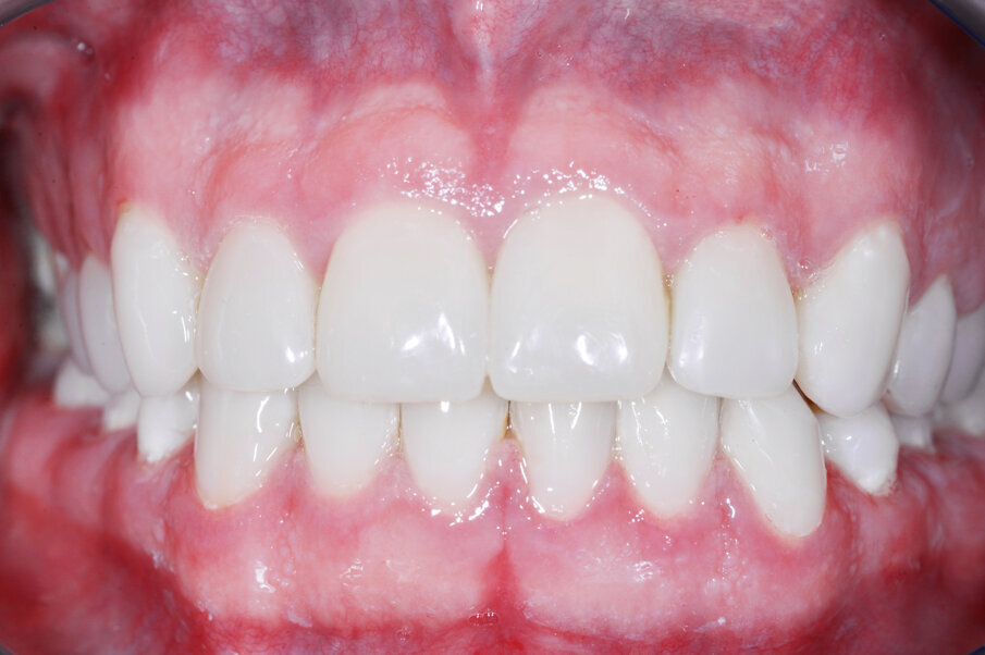 Figs. 16: Restoration in amelogenesis with novel BRILLIANT COMPONEER