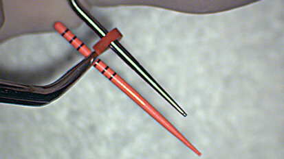 The continuous wave of obturation technique for enhanced precision The continuous wave of obturation technique for enhanced precision