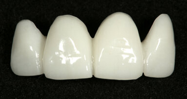 Integrating digital smile design into the analogue aesthetic workflow