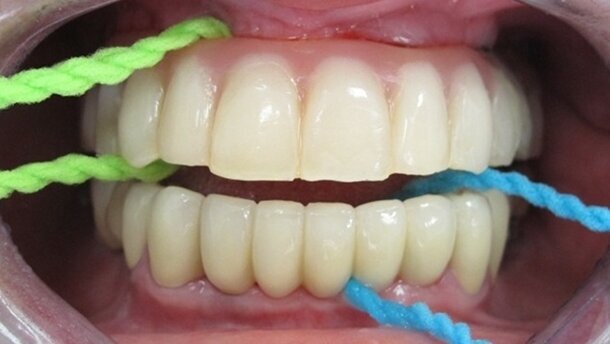 Let’s X-Floss those Implants