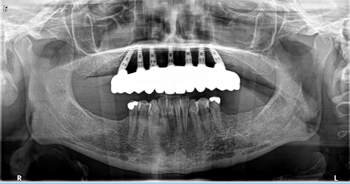 Fig. 19: Post-op panoramic radiograph.
