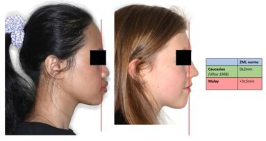 Zero meridian line norms in Malaysian Malay female adults