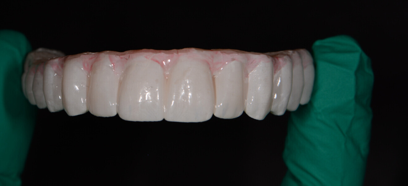 3: Printed all-on-X provisional restoration made from Rodin Sculpture (a nano-hybrid ceramic; Pac-Dent) and glazed with OPTIGLAZE (GC America).