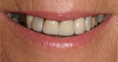 Intérêt des provisoires dans les cas de reconstructions complexes