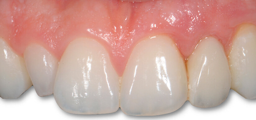 Fig. 7 - Controllo dei tessuti molli a 3 mesi, non è stato ancora riabilitato il conoide.