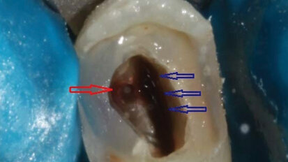 Ritrattamento endodontico e restauro adesivo di un secondo premolare strutturalmente compromesso