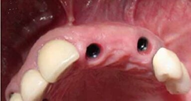 Šrafovima retinirana, implantatima nošena fiksna parcijalna proteza (FPP)