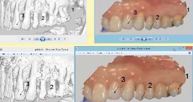 Προσωρινή αποκατάσταση με πλήρως ψηφιακή ροή