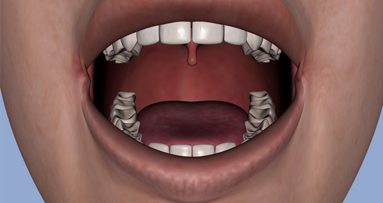 Rekonstruierter Oberkiefer aus dem 3-D-Drucker