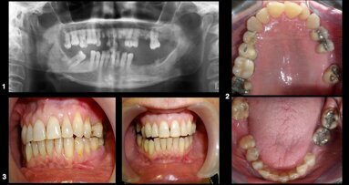 La atención odontológica del paciente con cáncer (1)