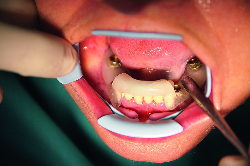 Fig. 7 : Insertion du gabarit dans la mandibule. 
