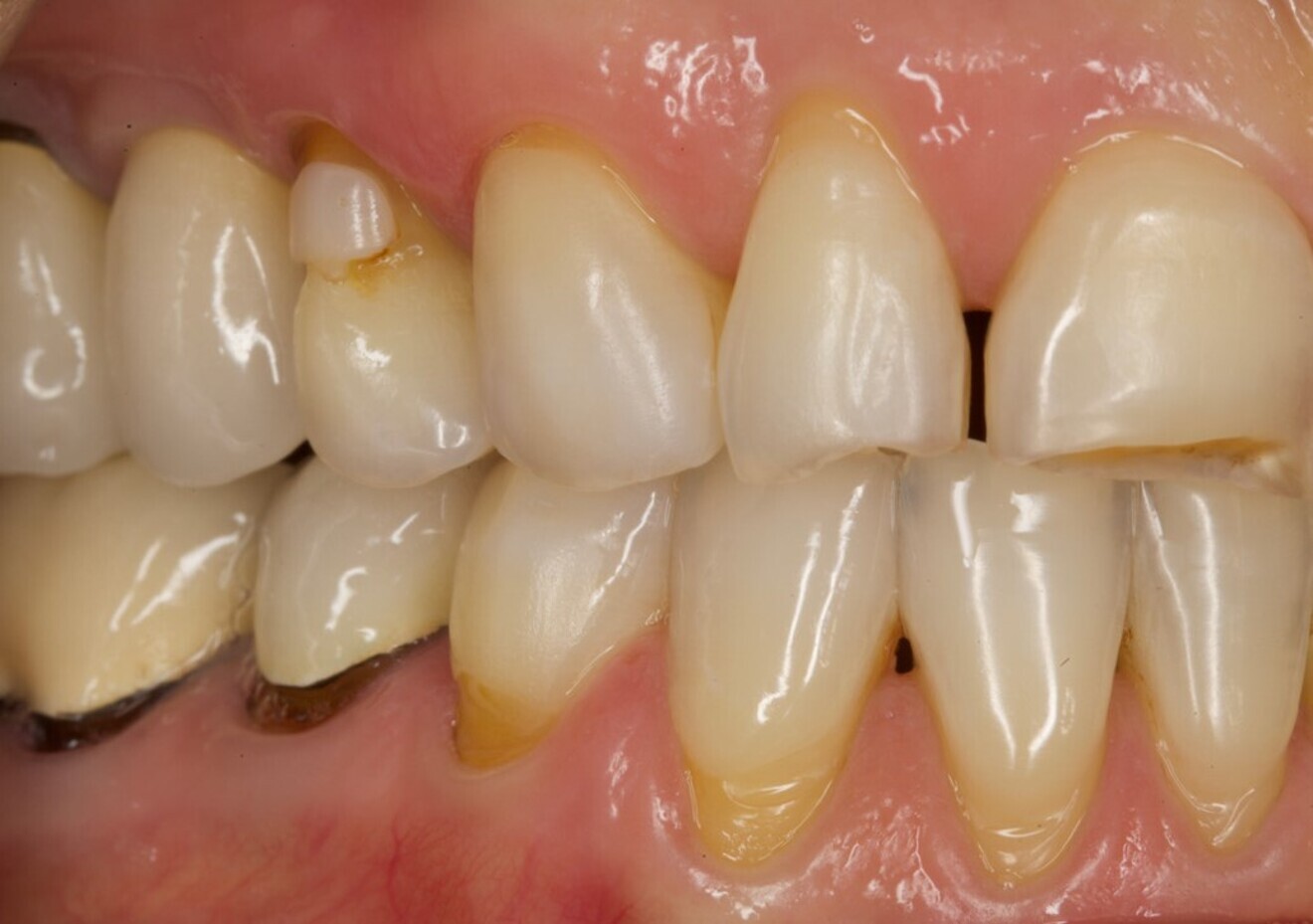 Fig. 1a: Initial situation. Lateral view from the right.