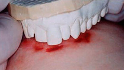 “Piano con l’attribuire ai morsi il valore di prova” dicono i ricercatori americani di Medicina legale