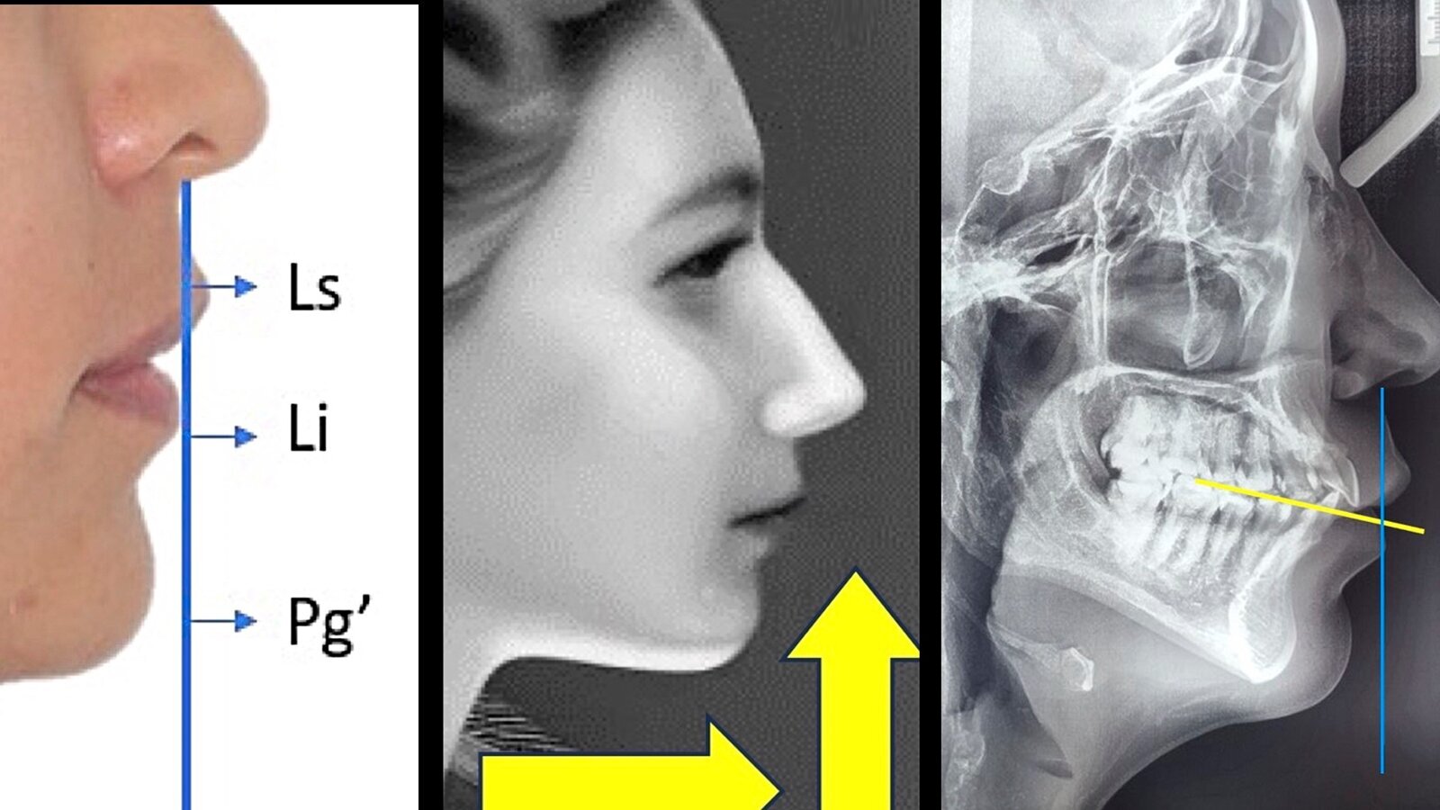 El control vertical del sector posterior mandibular