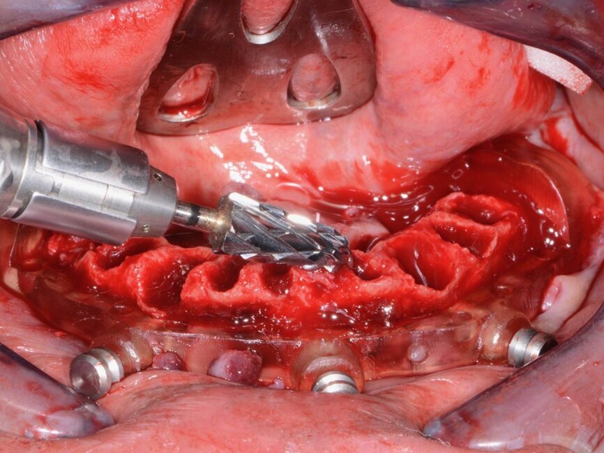 Fig. 13: Levelling bone using a CBCT-based guide.