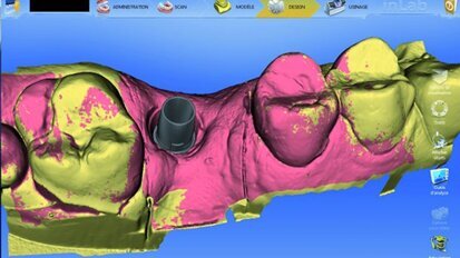 Cas clinique de couronnes sur piliers implantaires CFAO