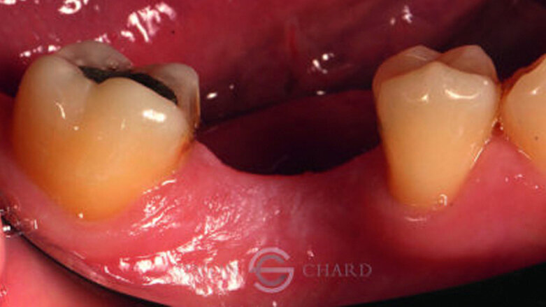 Implant restoration with CEREC