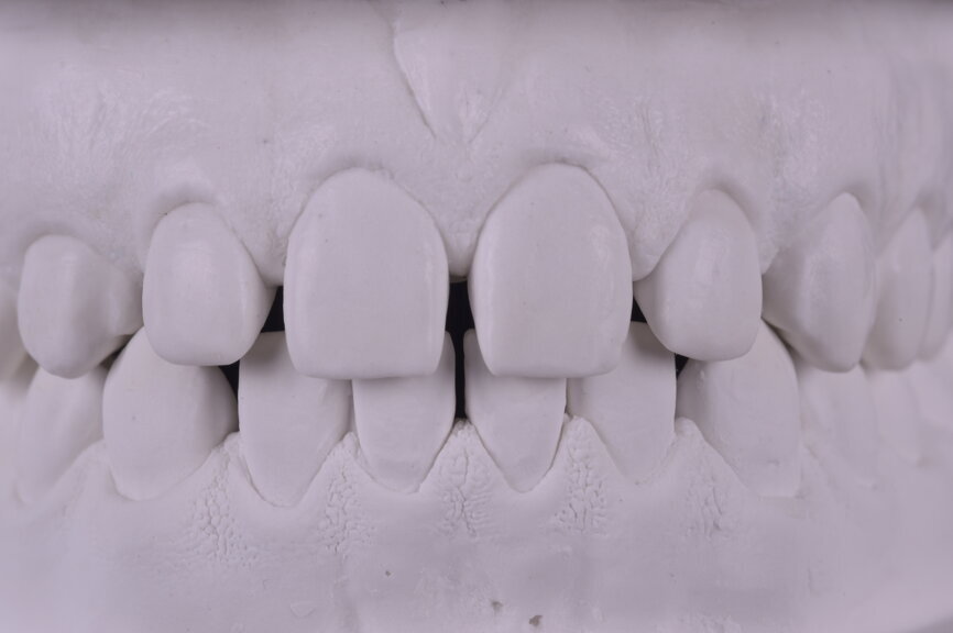 Fig. 19: Plaster model of the pre-op maxillary situation.