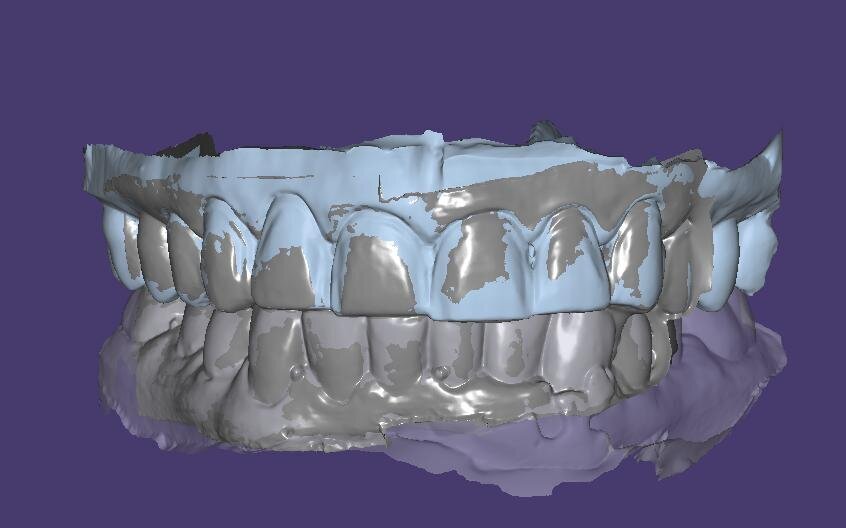 7: Maxillary and mandibular models
aligned displaying the bite record.