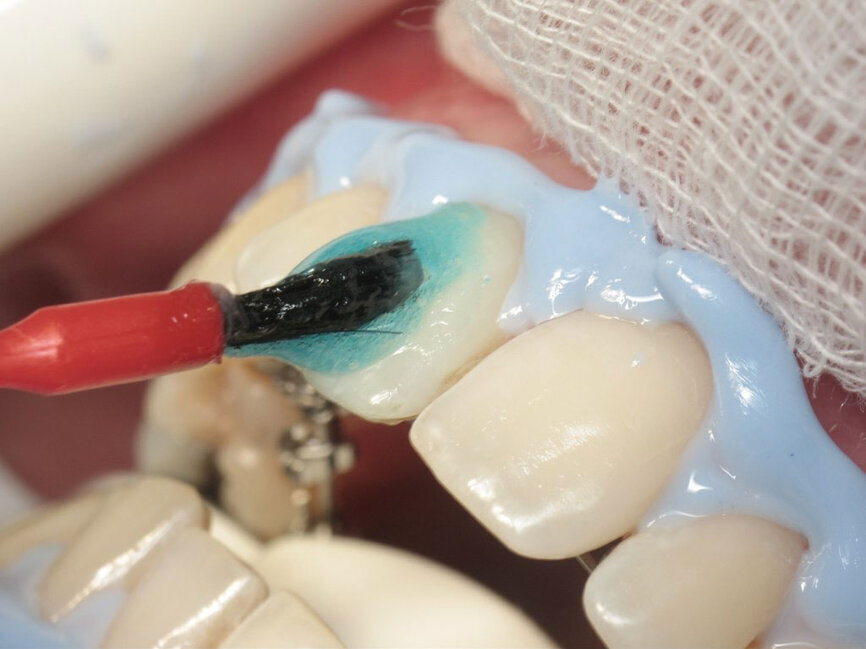 Figura 3. Aplicación de gel blanqueador de dientes en la cara vestibular de los dientes.