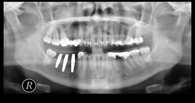 Metallfreie Implantate: Wunsch oder Wirklichkeit?