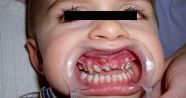 Narkose-Sparkurs: Kinderzahnärzte und Anästhesisten schlagen Alarm