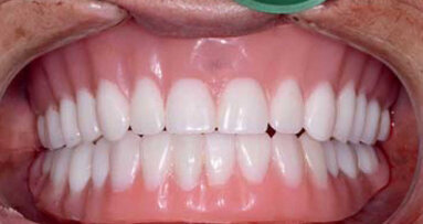 L’apport des solutions CFAO aux restaurations complètes sur implants