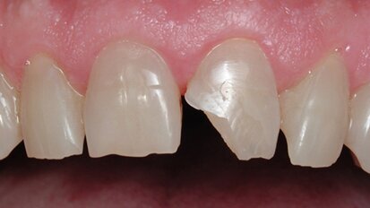 Figura 1. Diente central con fractura de ángulo. Figura 1. Diente central con fractura de ángulo.