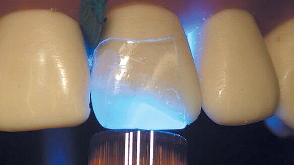 Directa CoForm matrix system provides transparent corner matrices