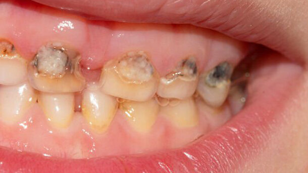 I batteri orali delle madri possono provocare carie nei loro figli