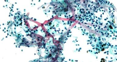 Mucor due to hyperglycemia from new strain?