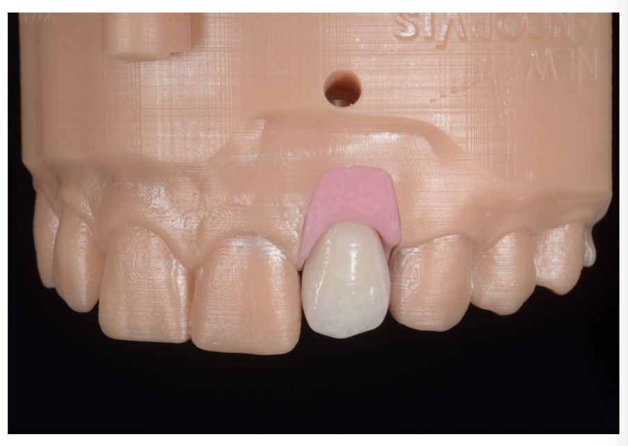 Fig. 13_Ceramizzazione finale su modello.
