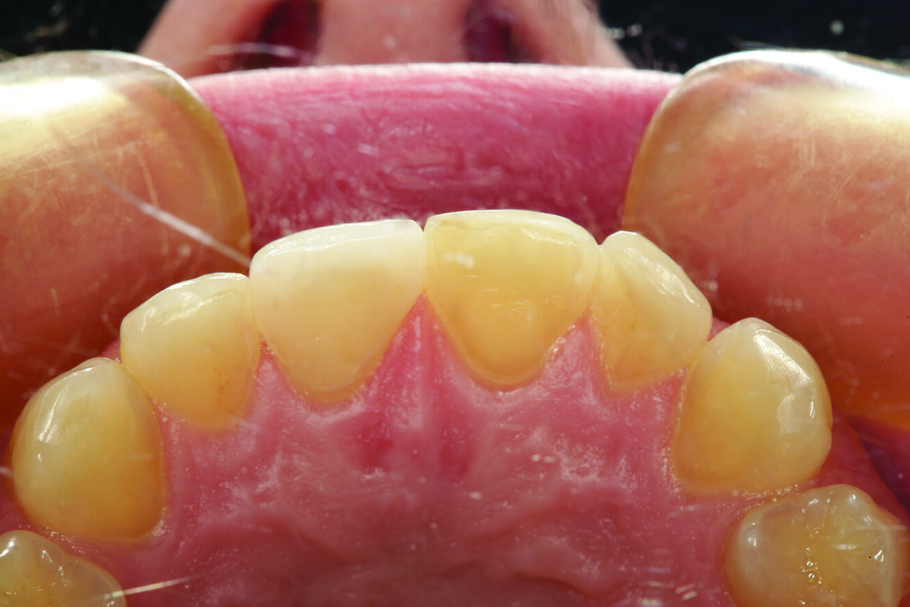 Fig. 16: Palatal view of the ceramic crown on tooth #11, showing replication of the palatal concavity with supragingival margin placement.