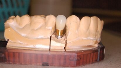 Prace z kompozytów technicznych na implantach stomatologicznych