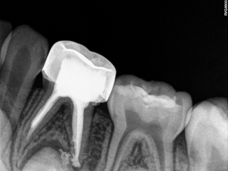 Fig. 11 : Obturation et restauration définitive.