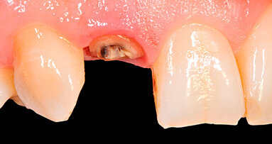 Risoluzione morfologico-estetica di un incisivo laterale: approccio mini-invasivo