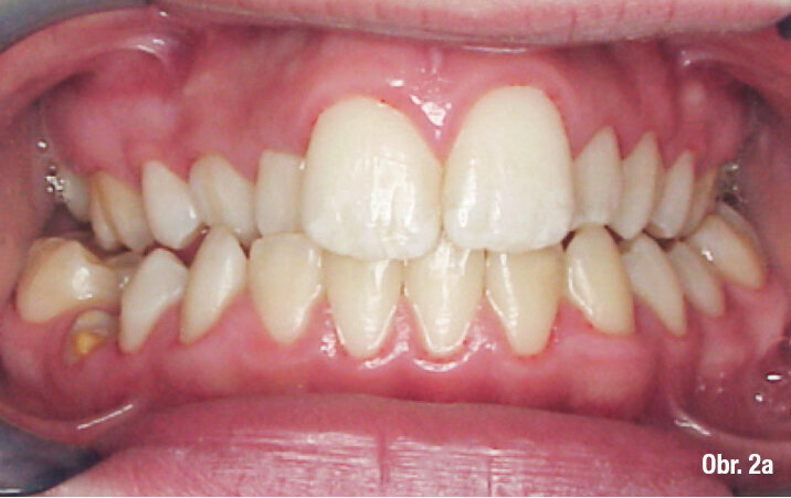 Laterálně otevřený skus často spojený s konstrikcí v horním zubním oblouku. Je často důsledkem sekundárního ústního dýchání a chronické dysbalance mezi pozicí jazyka a aktivitou m. buccinator (obličejové svalstvo).