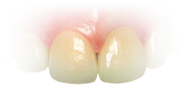 丙烯酸酯被评为“年度过敏原”