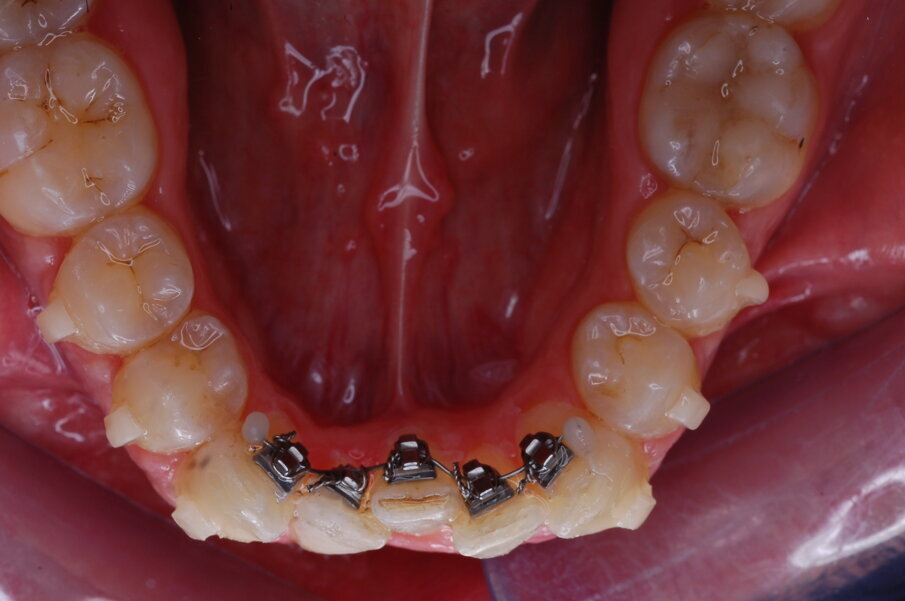 Fig. 32_Apparecchio linguale sezionale in posizione. 