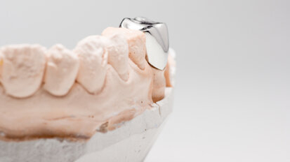 Study proves effectiveness of stainless-steel crowns in restoring permanent teeth Study proves effectiveness of stainless-steel crowns in restoring permanent teeth