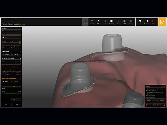 Okraje abutmentu je také možné upravovat a navrhovat individuálně.
