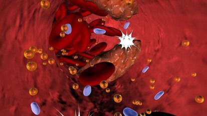 Lijekovi za holesterol pomažu pri smanjenju upale desni kod srčanih bolesnika