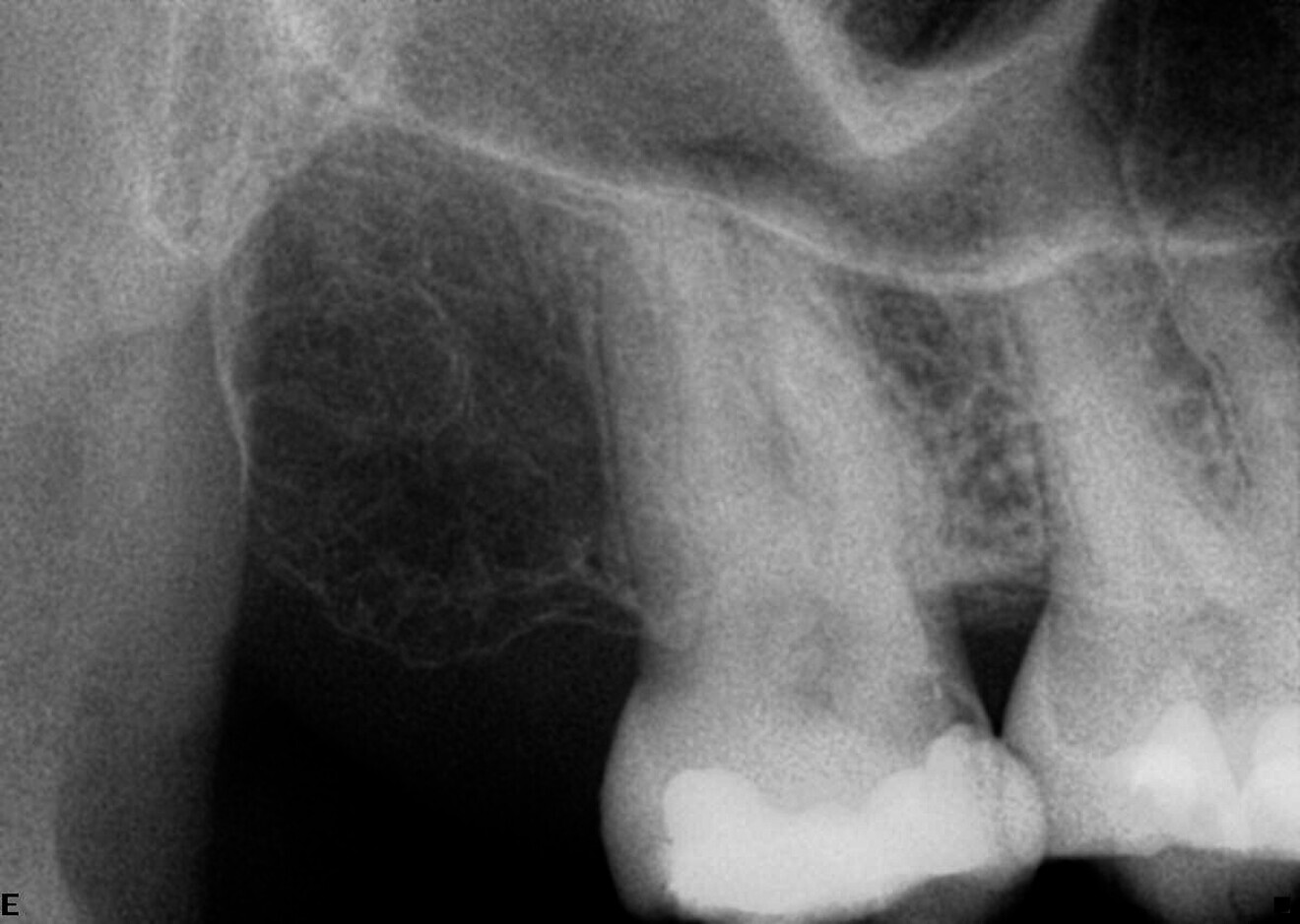 Case 2—Fig. 7: Initial periapical radiograph.