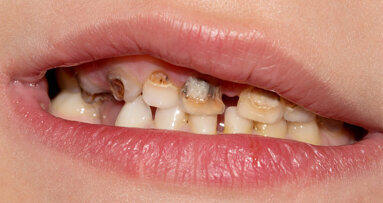 Tooth extractions are main reason for children's hospital admissions