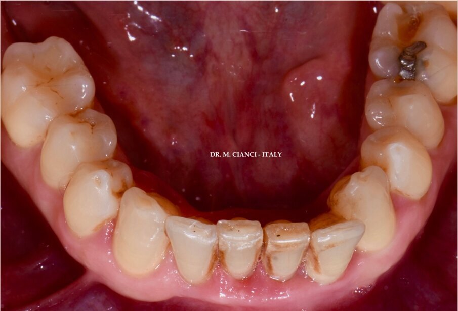 Fig. 1 - Incisivi inferiori in visione occlusale.