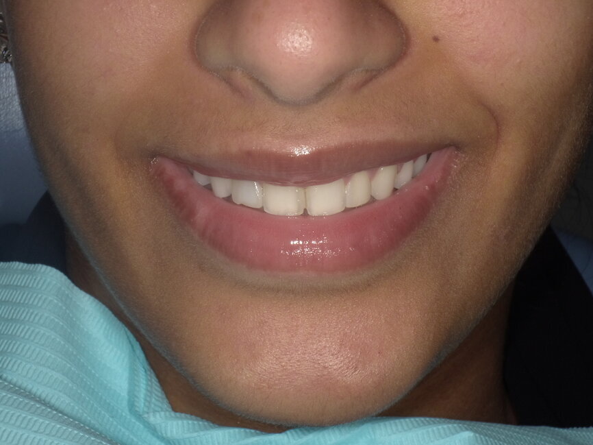 Fig 1: Pre-operative macro view of patient smile